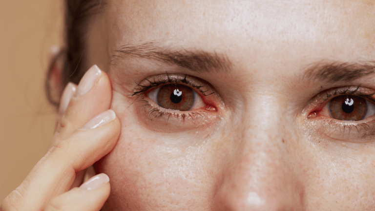 ojos rojos y resecos
